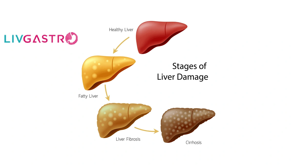 The Alarming Rise of NAFLD | It's Not Just About Alcohol