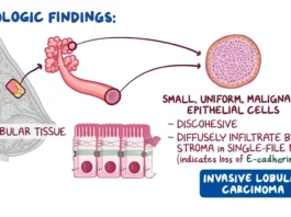 Invasive Lobular Carcinoma