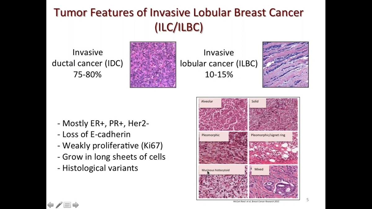 The "Why" | Invasive Lobular Carcinoma On the Rise