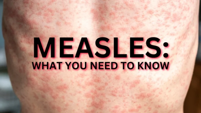 Measles Outbreak