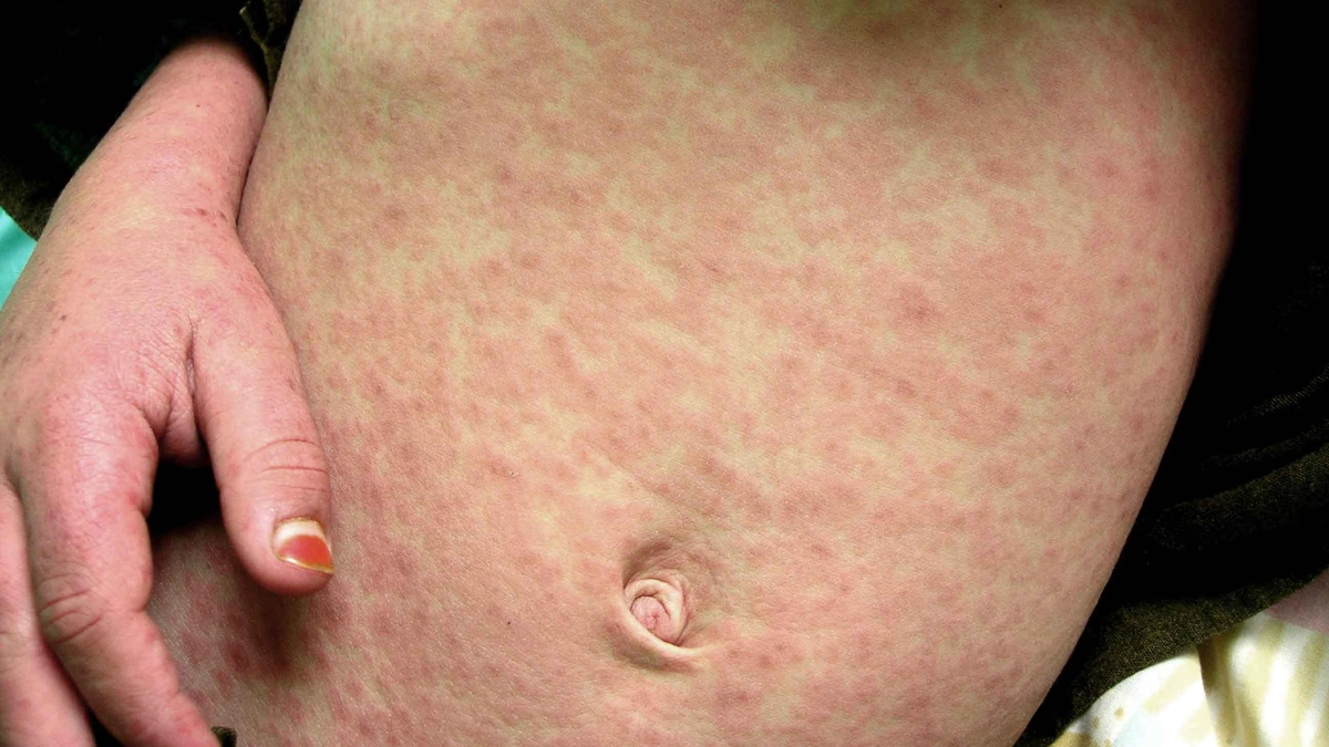 Why This Measles Outbreak Matters – Especially Now