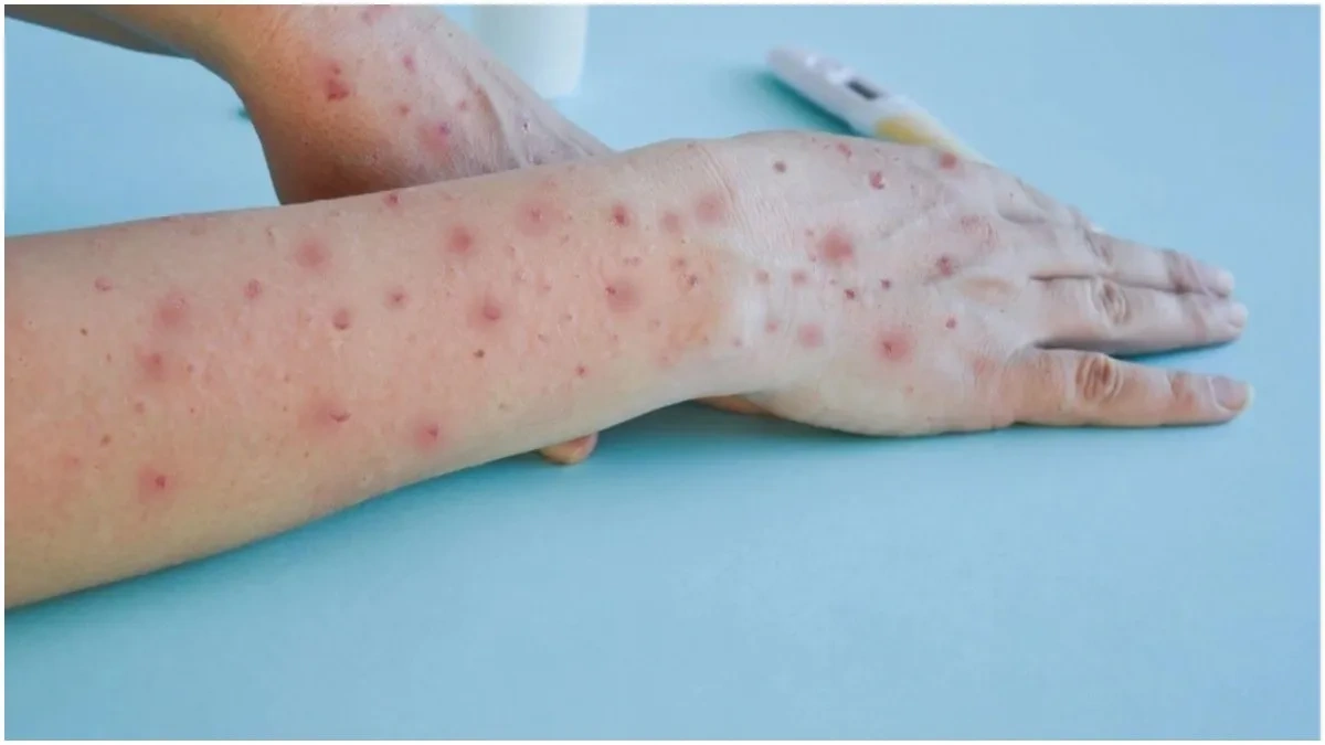 Understanding the Current Mpox Situation in California