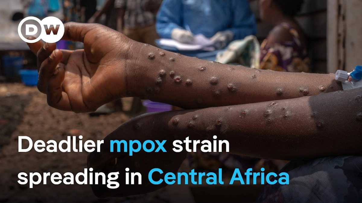 What Makes This Mpox Case Different?