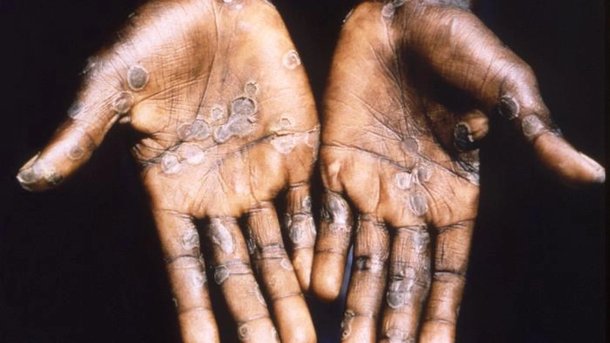 Why Clade I Mpox is a Concern