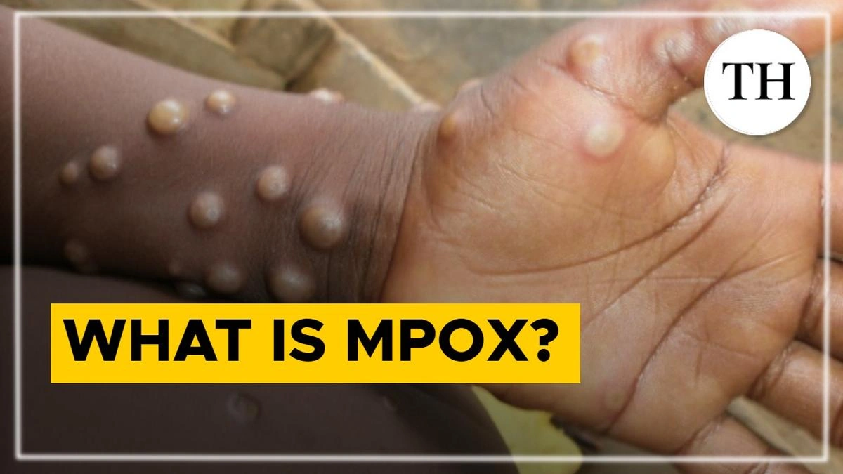 What's the Deal with Clade I Mpox?
