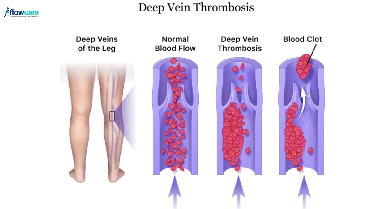 Why Should I Care About Thrombosis?