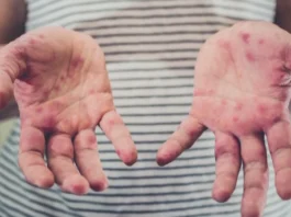 measles exposure