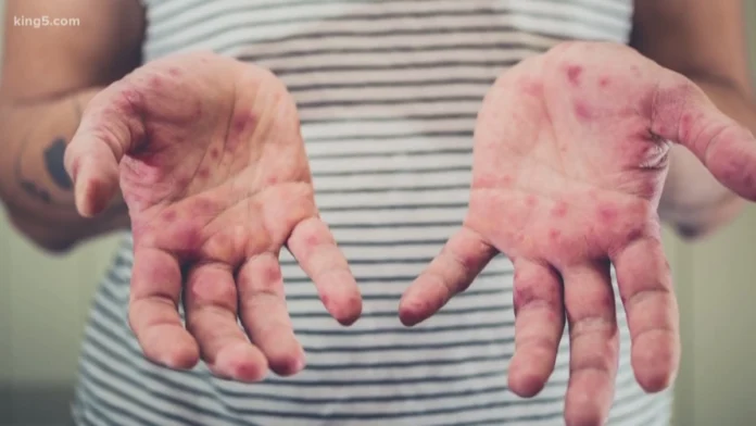 measles exposure