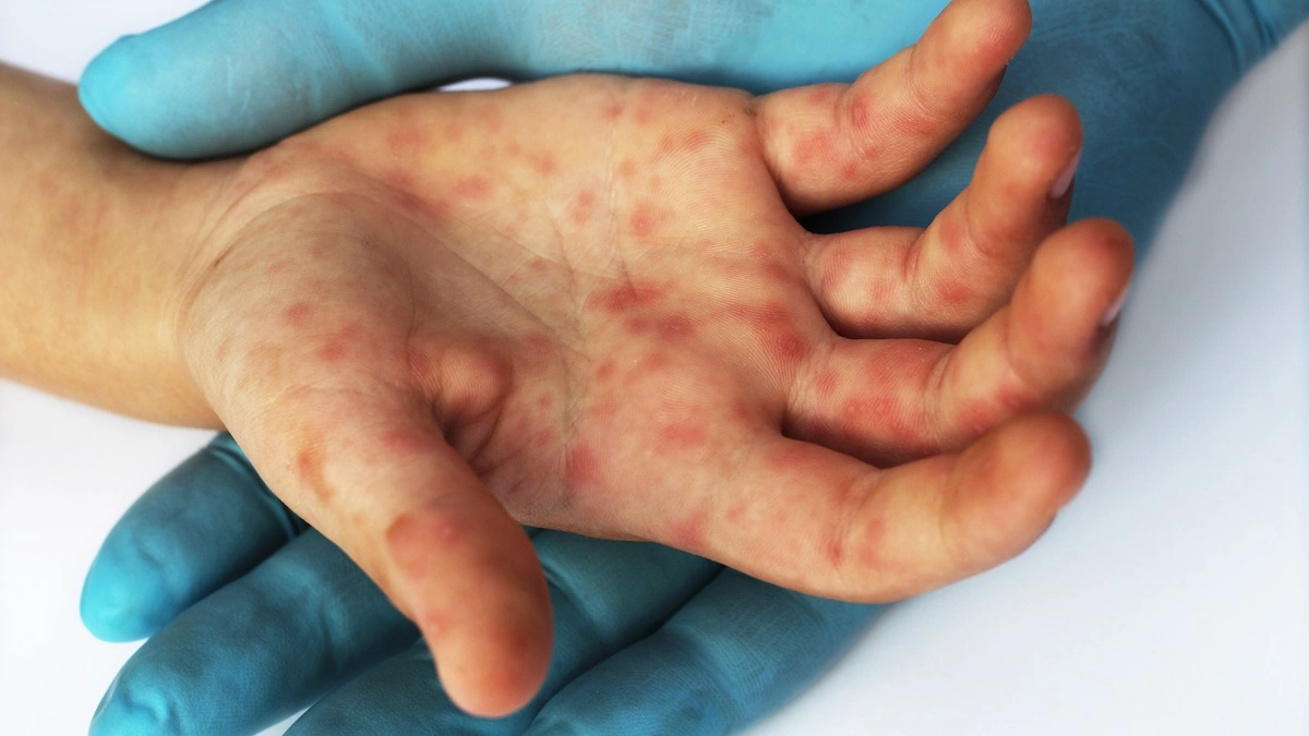 Why Should We Care About a Measles Exposure?