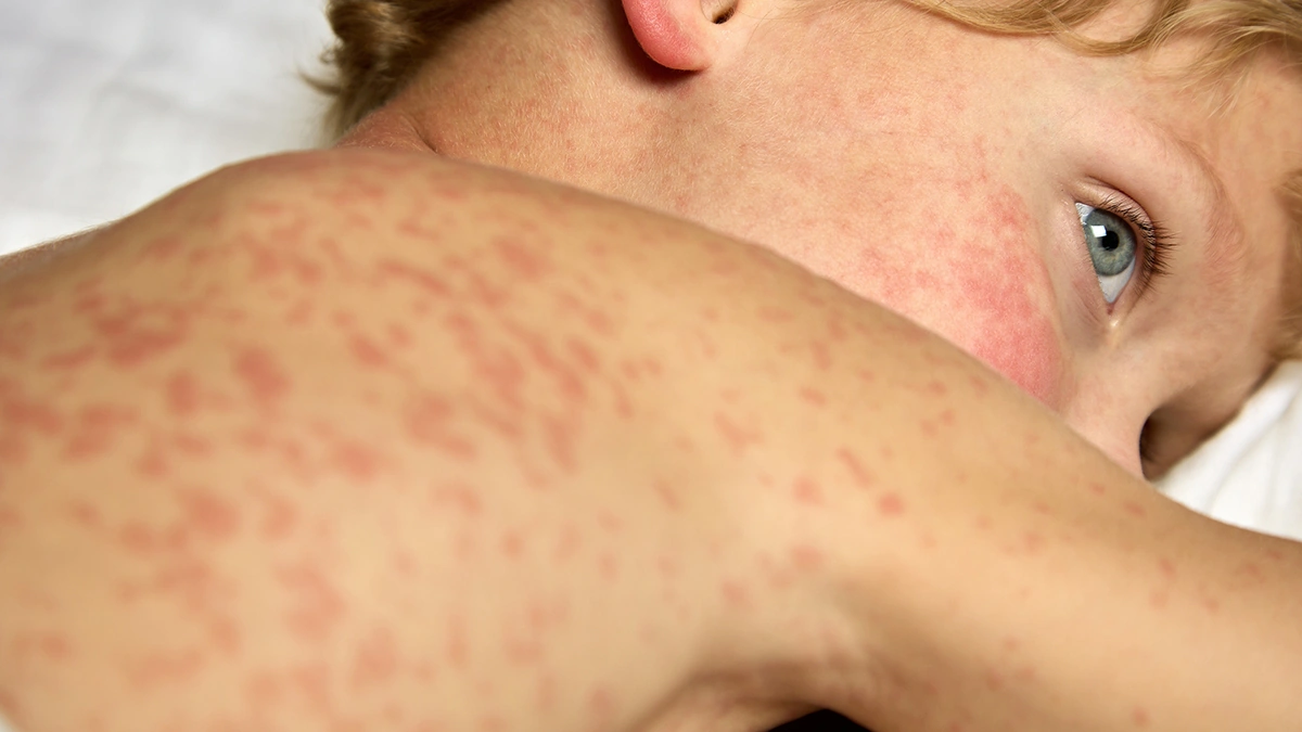 Why Measles Is Making a Comeback (And Why You Should Care)