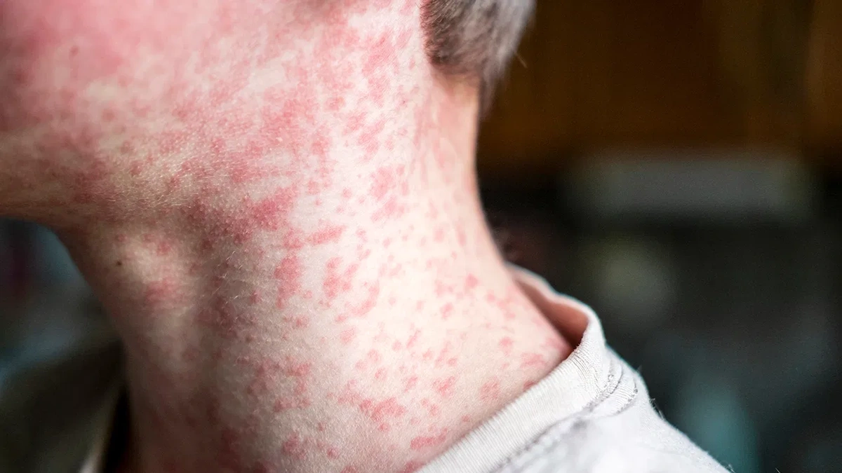 Why Should You Care About US Measles Cases From India?