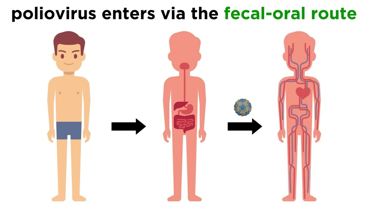 What Really Was Polio? (Beyond the Textbook Definition)